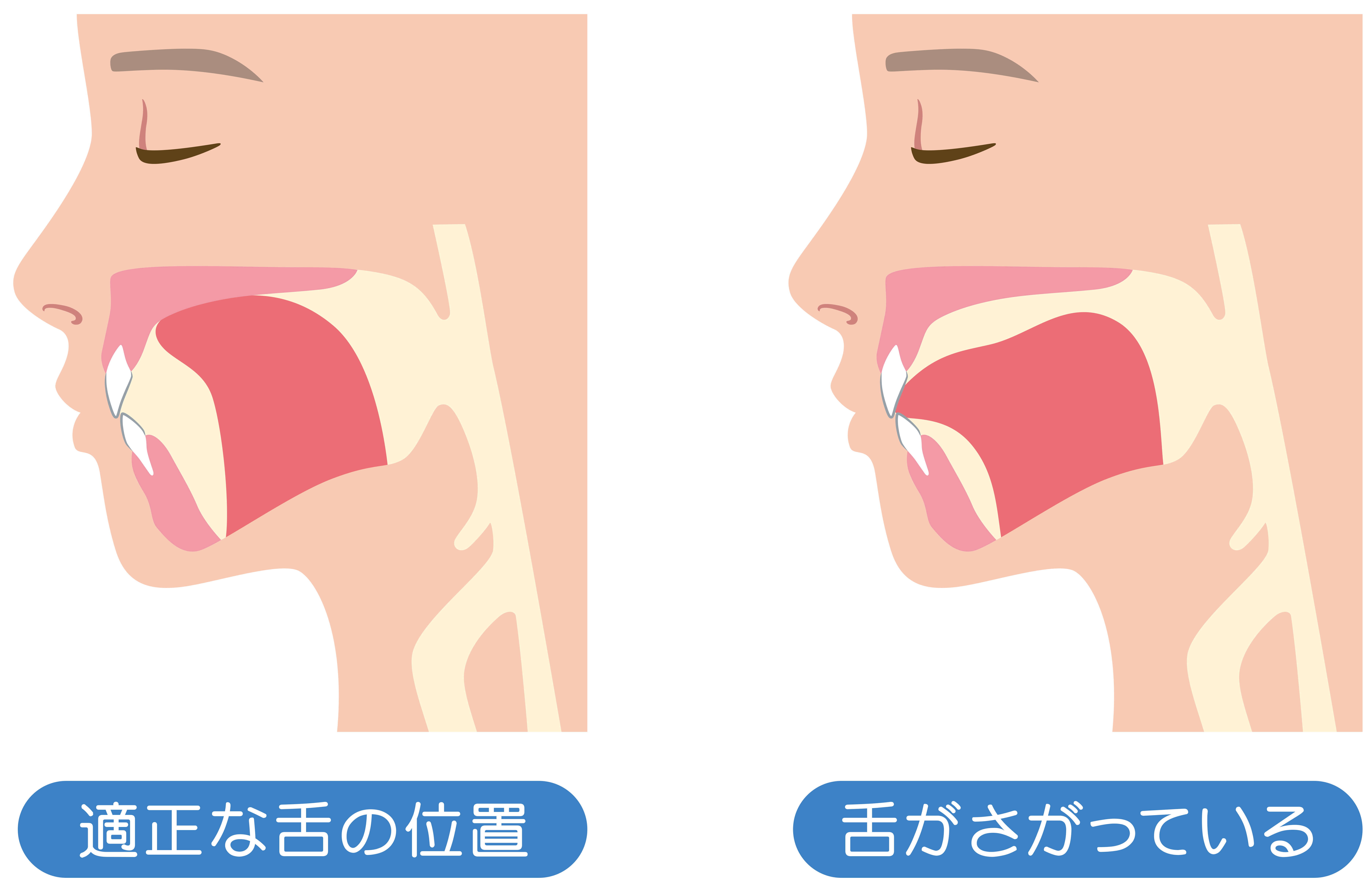 しみず歯科｜雪が谷大塚（大田区南雪谷）の歯医者、しみず歯科のMFT（口腔筋機能療法）